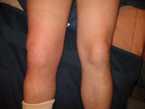 Ревматоидный артрит сустава колена